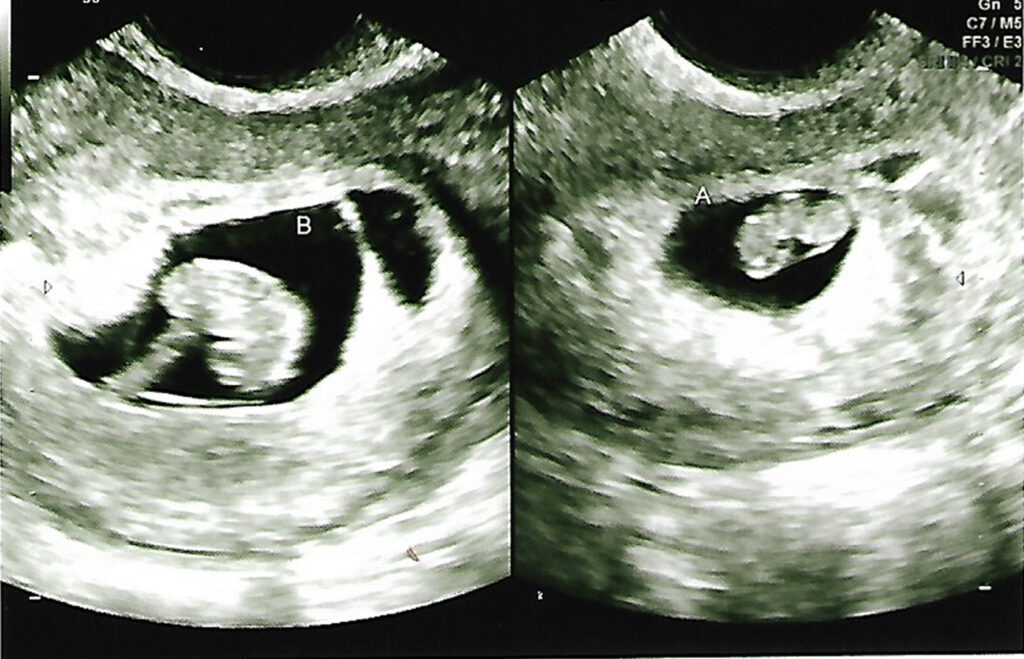 I'm having twins now what?